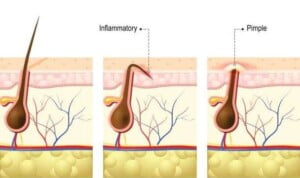 Do Safety Razors Reduce Ingrown Hairs?